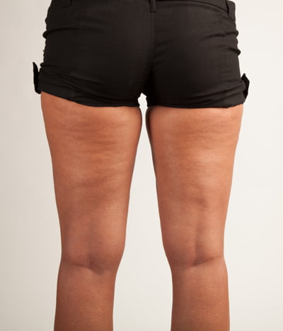 I'm Skinny With Cellulite - Is this normal?