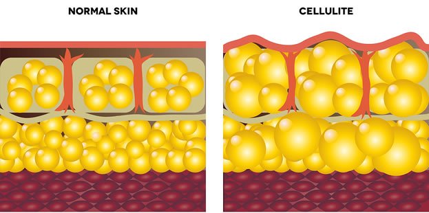 I'm Skinny With Cellulite - Is this normal? Cellulite-Cross-Section